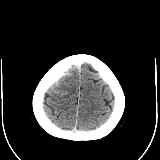 File:Carotico ophthalmic aneurysm (Radiopaedia 42916-46147 Axial non-contrast 23).png