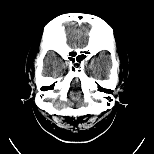 File:Carotico ophthalmic aneurysm (Radiopaedia 42916-46147 Axial non-contrast 3).png