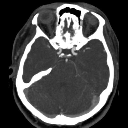 File:Carotico ophthalmic aneurysm (Radiopaedia 42916-46148 C 4).png