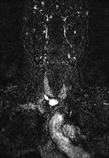 Carotid artery dissection (Radiopaedia 28441-28689 Coronal MRA 16).jpg