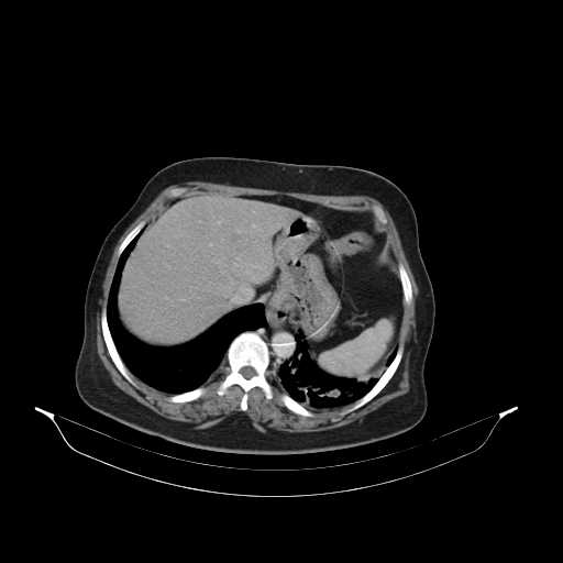 File:Carotid body tumor (Radiopaedia 21021-20948 B 57).jpg