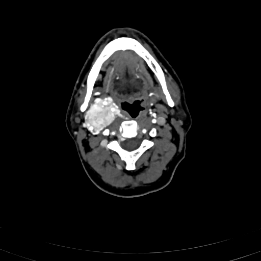File:Carotid body tumor (Radiopaedia 83615-98727 A 51).jpg