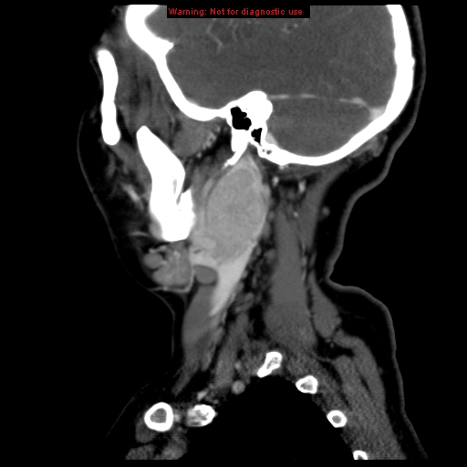 Carotid body tumor with lung metastases (Radiopaedia 9301-9986 Sagittal C+ delayed 41).jpg