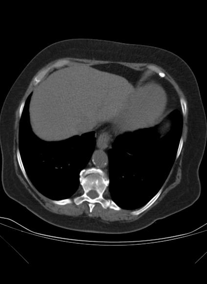 File:Caseous mitral annular calcification (Radiopaedia 61219-69122 Axial non-contrast 21).jpg