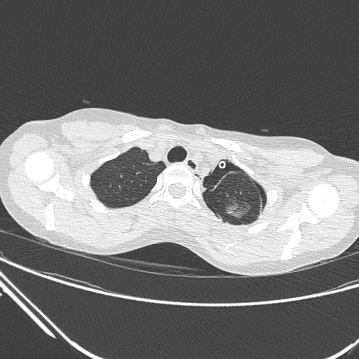 Catamenial pneumothorax (Radiopaedia 27946-28197 lung window 31).jpg