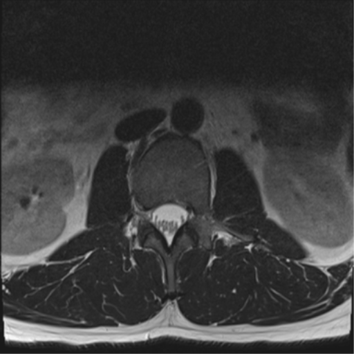 File:Cauda equina syndrome (Radiopaedia 53615-59672 Axial T2 31).png
