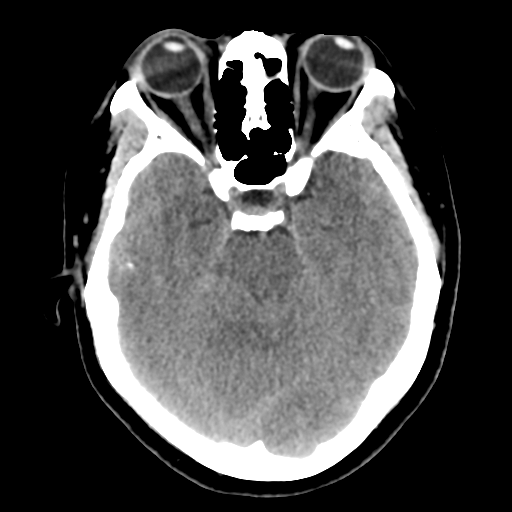 Cavernoma with hemorrhage (Radiopaedia 70755-80931 Axial non-contrast 19).png