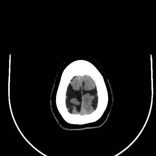 Cavernous hemangioma of the cerebellar falx (Radiopaedia 73025-83723 Axial non-contrast 130).jpg