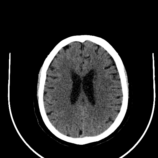 Cavernous hemangioma of the cerebellar falx (Radiopaedia 73025-83723 Axial non-contrast 91).jpg