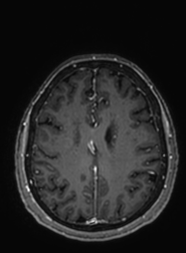 File:Cavernous hemangioma of the cerebellar falx (Radiopaedia 73025-83724 Axial T1 C+ 106).jpg