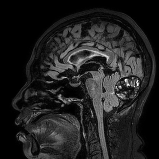 File:Cavernous hemangioma of the cerebellar falx (Radiopaedia 73025-83724 Sagittal FLAIR 109).jpg