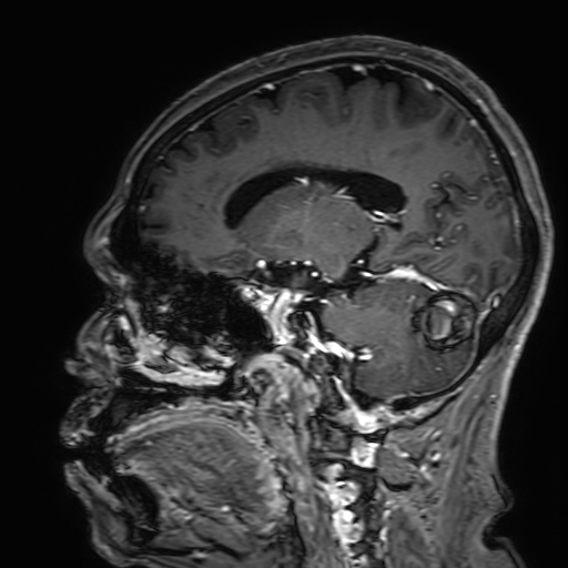 Cavernous hemangioma of the cerebellar falx (Radiopaedia 73025-83724 Sagittal T1 C+ 85).jpg