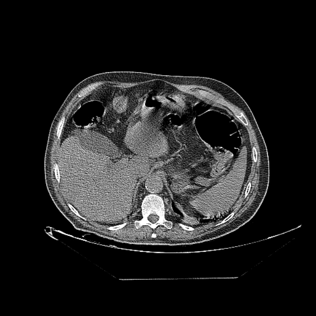 Cavitating bronchogenic carcinoma (Radiopaedia 44489-48162 Axial non-contrast 84).jpg