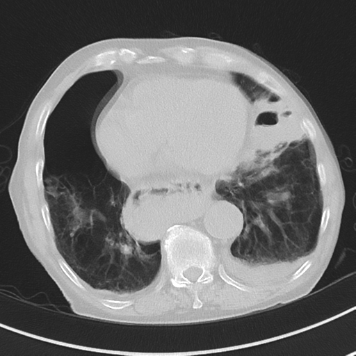 Cavitating pneumonia - lingular segments (Radiopaedia 34386-35678 Axial lung window 44).png