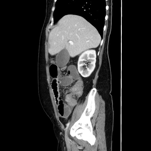 Cecal adenocarcinoma (Radiopaedia 75909-87331 C 24).jpg