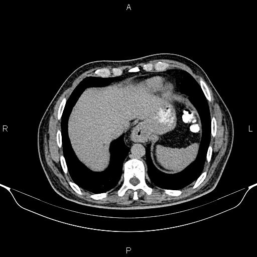 Cecal adenocarcinoma (Radiopaedia 85324-100916 Axial C+ delayed 12).jpg