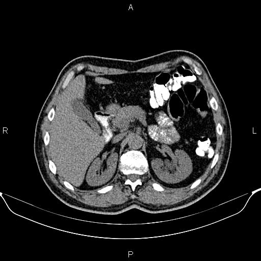 Cecal adenocarcinoma (Radiopaedia 85324-100916 Axial non-contrast 28).jpg