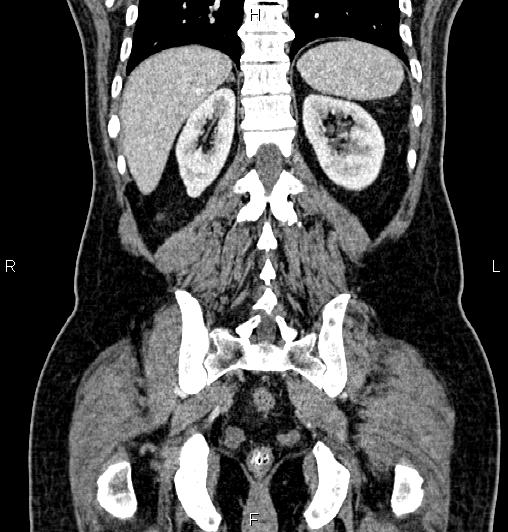 File:Cecal adenocarcinoma (Radiopaedia 85324-100916 D 51).jpg
