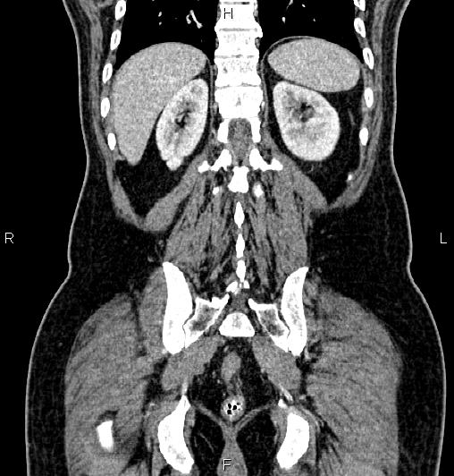 Cecal adenocarcinoma (Radiopaedia 85324-100916 D 53).jpg