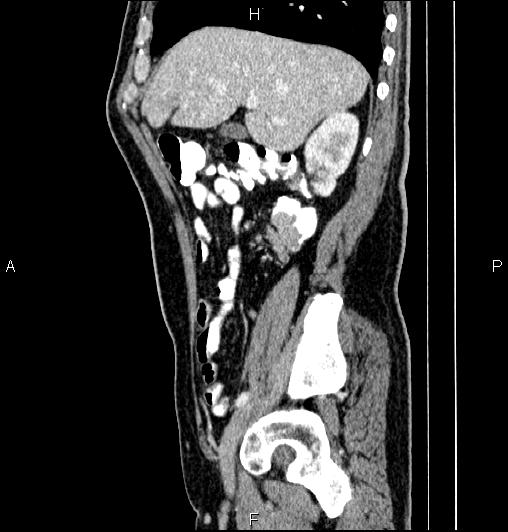 Cecal adenocarcinoma (Radiopaedia 85324-100916 E 26).jpg