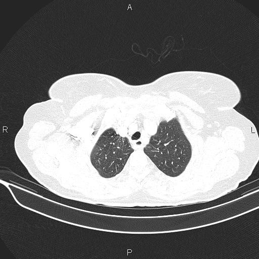 Cecal cancer (Radiopaedia 85610-101358 Axial lung window 12).jpg