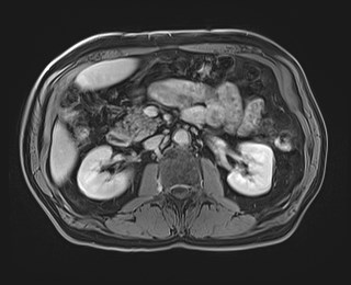 Cecal mass causing appendicitis (Radiopaedia 59207-66532 J 59).jpg