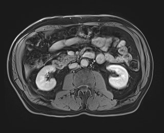 Cecal mass causing appendicitis (Radiopaedia 59207-66532 J 65).jpg