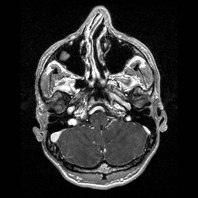 Central-variant posterior reversible encephalopathy syndrome (PRES) (Radiopaedia 43880-47358 Axial T1 C+ 22).jpg