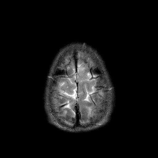 File:Central-variant posterior reversible encephalopathy syndrome (PRES) (Radiopaedia 43880-47358 Axial T2 23).jpg