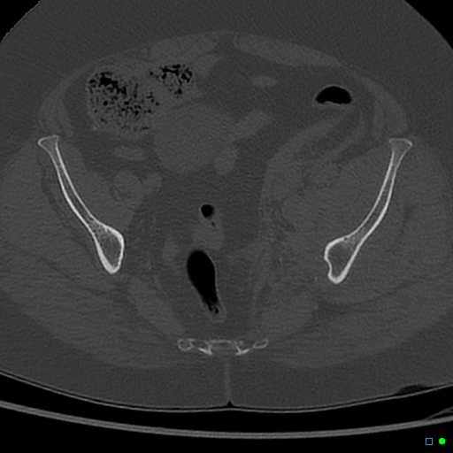 File:Central fracture-dislocation of the acetabulum (Radiopaedia 36578-38150 Axial bone window 34).jpg