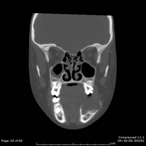 Central giant cell granuloma (Radiopaedia 45612-49754 Coronal bone window 20).jpg