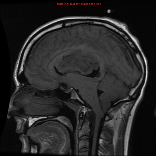 File:Central neurocytoma (Radiopaedia 13188-13206 Sagittal T1 8).jpg