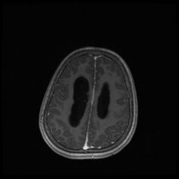 Central neurocytoma (Radiopaedia 30220-30842 Axial T1 C+ 112).jpg