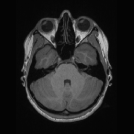 File:Central neurocytoma (Radiopaedia 37664-39557 Axial T1 19).png