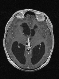 Central neurocytoma (Radiopaedia 56690-63469 Axial T1 C+ 76).jpg