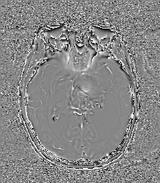 Central neurocytoma (Radiopaedia 84497-99872 Axial 32).jpg