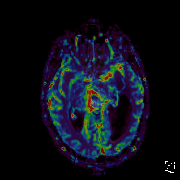 Central neurocytoma (Radiopaedia 84497-99872 Axial Perfusion 181).jpg