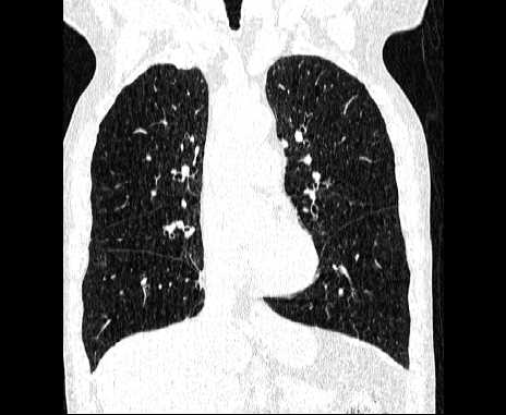 Centrilobular pulmonary emphysema (Radiopaedia 62468-70718 Coronal lung window 31).jpg