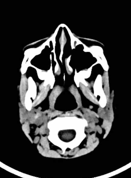 File:Cerebellar abscess (Radiopaedia 73727-84527 Axial non-contrast 14).jpg