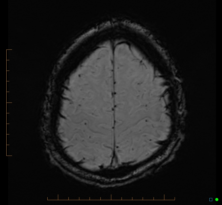 Cerebellar gangliocytoma (Radiopaedia 65377-74422 Axial SWI 51).jpg