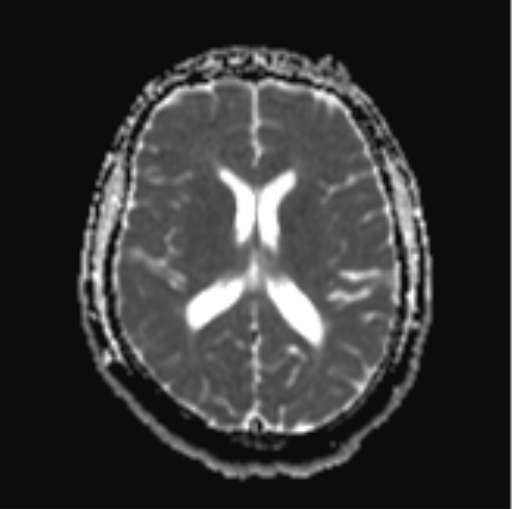 File:Cerebellar hemangioblastomas and pituitary adenoma (Radiopaedia 85490-101176 Axial ADC 20).png