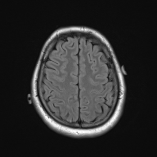 File:Cerebellar hemangioblastomas and pituitary adenoma (Radiopaedia 85490-101176 Axial FLAIR 23).png