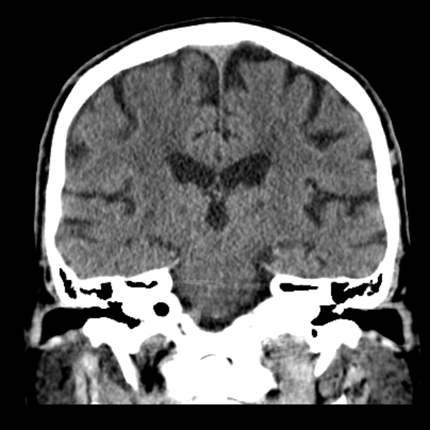 Cerebellar hemorrhage (Radiopaedia 27193-27359 Coronal non-contrast 33).jpg
