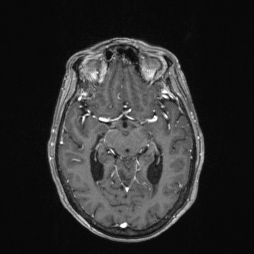 Cerebellar metastases (Radiopaedia 24038-24249 Axial T1 C+ 20).jpg