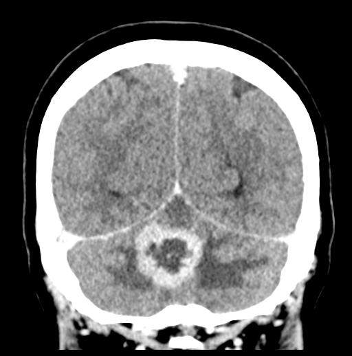 Cerebellar metastasis (Radiopaedia 54578-60812 Coronal C+ 47).png