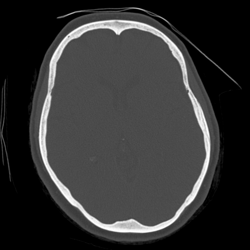 Cerebellar metastasis (cystic appearance) (Radiopaedia 41395-44258 Axial bone window 34).png