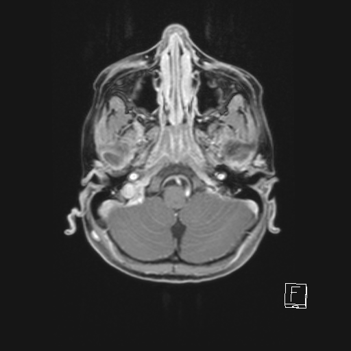 Cerebellar stroke (Radiopaedia 32202-33150 Axial T1 C+ 20).png