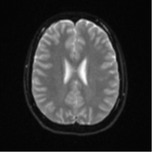 Cerebellar tuberculomas (Radiopaedia 46939-51472 Axial DWI 19).png