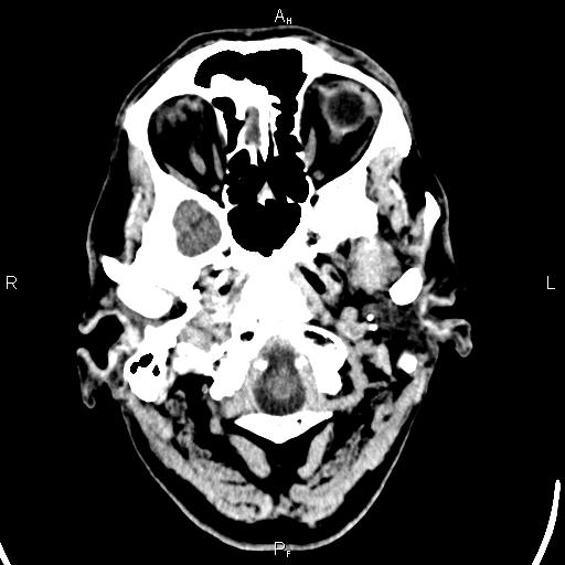 Cerebellopontine angle arachnoid cyst (Radiopaedia 85149-100704 Axial With contrast 1).jpg