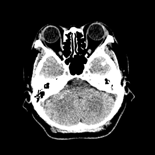 Cerebellopontine angle meningioma (Radiopaedia 53561-59592 Axial non-contrast 16).jpg